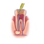 root canals, dental pain, tooth infection, painless root canal, Neaville Family Dentistry, Searcy AR