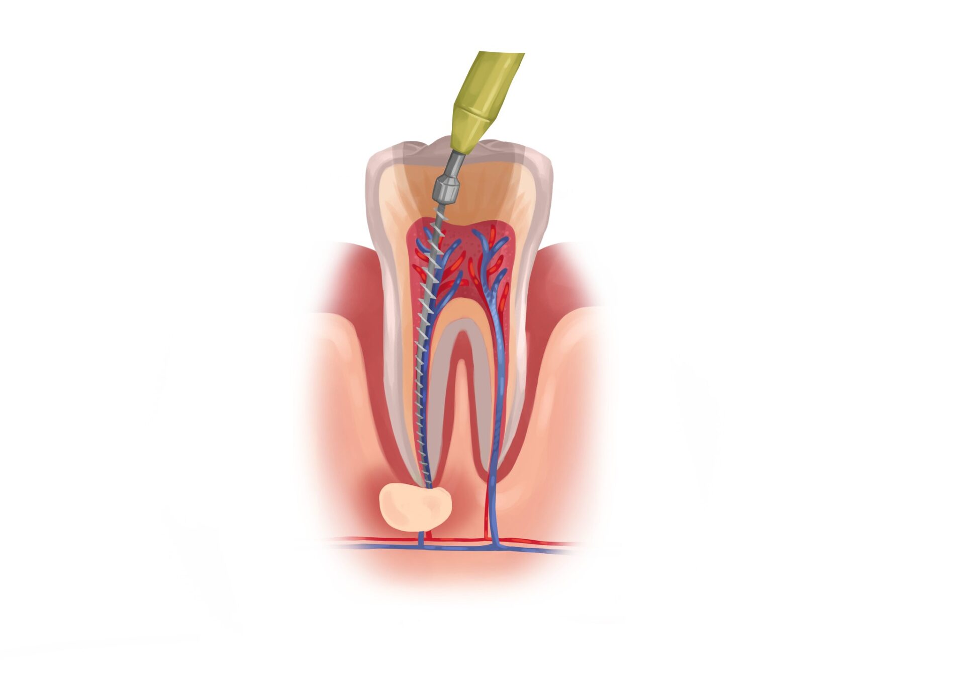 root canals, dental pain, tooth infection, painless root canal, Neaville Family Dentistry, Searcy AR