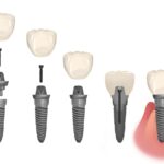 dental implants parts and process