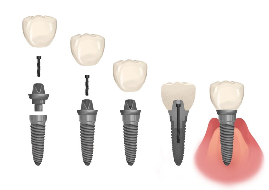 dental implants parts and process